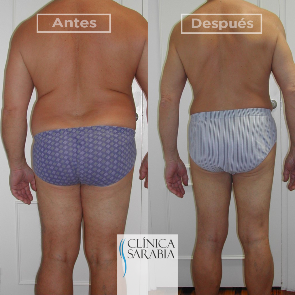 Tratamiento para la obesidad en Getxo y Leioa