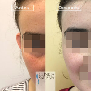 Otoplastia o cirugía de las orejas