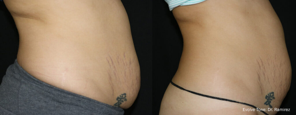 HR EvolveToneAbdomen 1