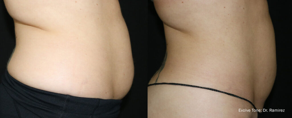 HR EvolveTone Abdomen 2