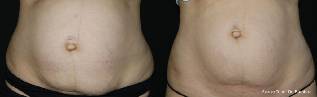 HR EvolveTone Abdomen 3