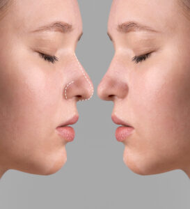 rinoplastia cerca de Getxo y Leioa