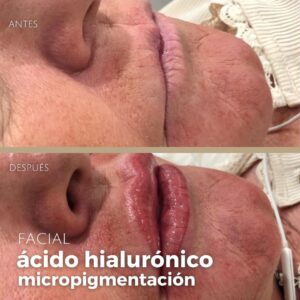 Dermopigmentación 21 2410 1