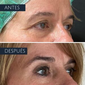 Precios para eliminar los párpados caídos en Bilbao