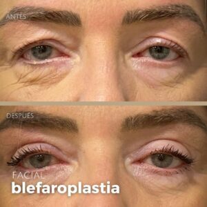 Precio de blefaroplastia en Gorliz, Sopela y Urduliz