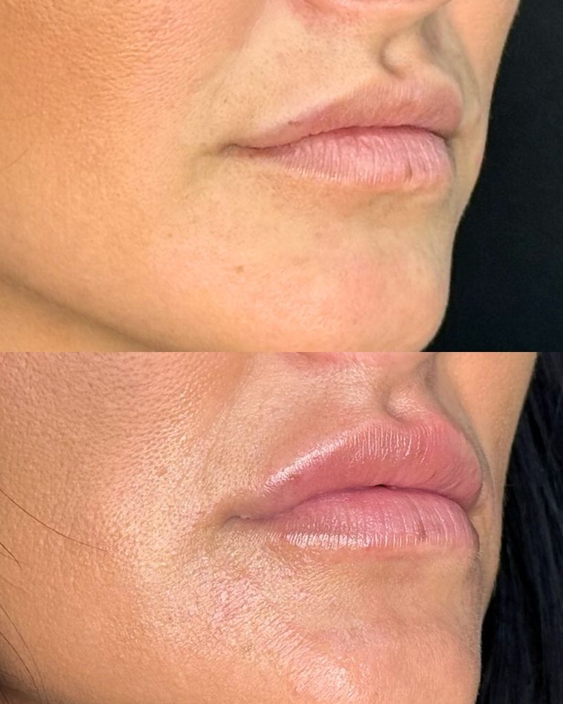 Acido hialurónico 15 aumento de labios en bilbao precio