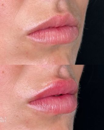 aumento-labios-bilbao